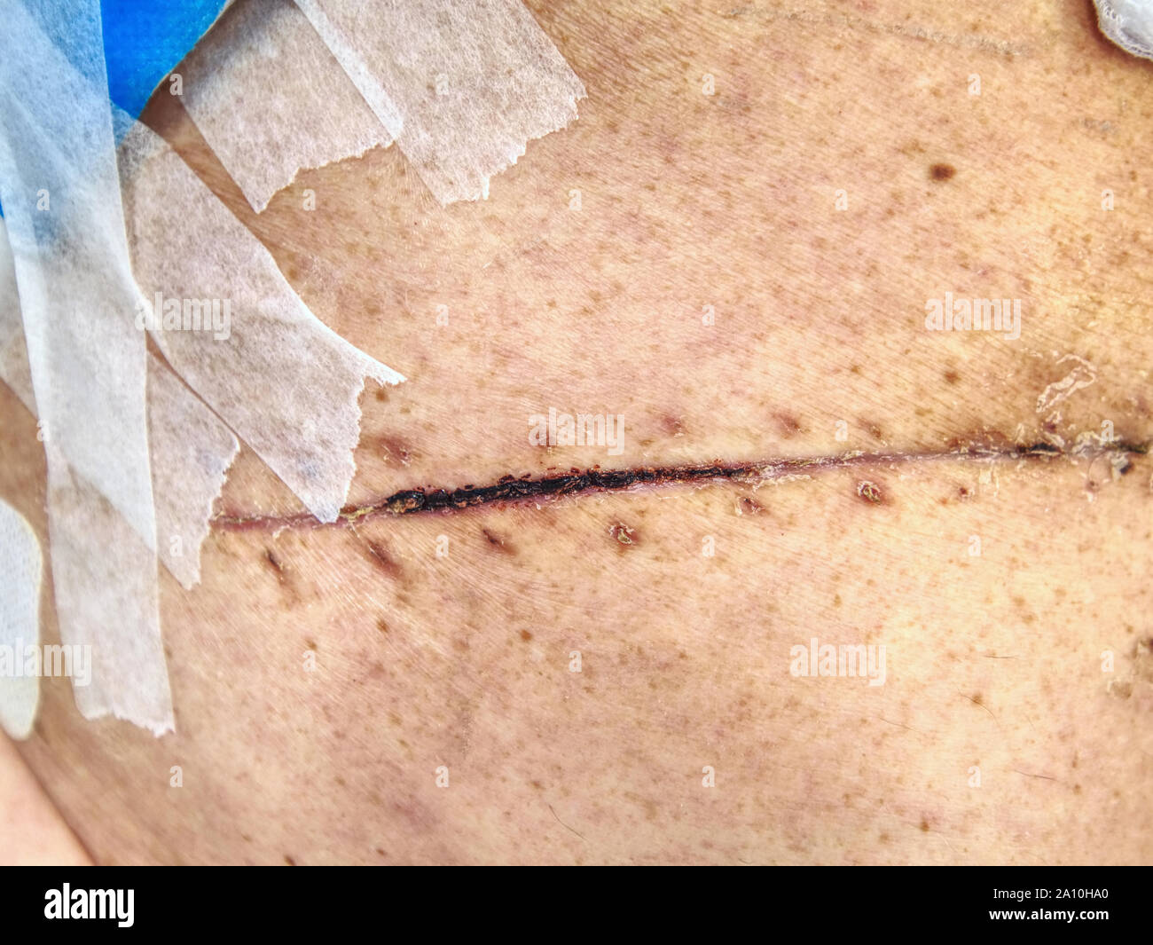 Father after cancer  liver and bowel cancer surgery. Bandage of fresh scar on the abdomen and side of male body. Stock Photo