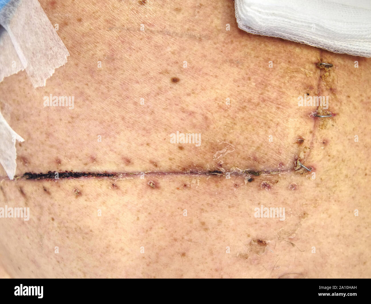 Belly wound with surgical silver stitch. Patient after intestinal cancer and gallbladder removal. Stock Photo