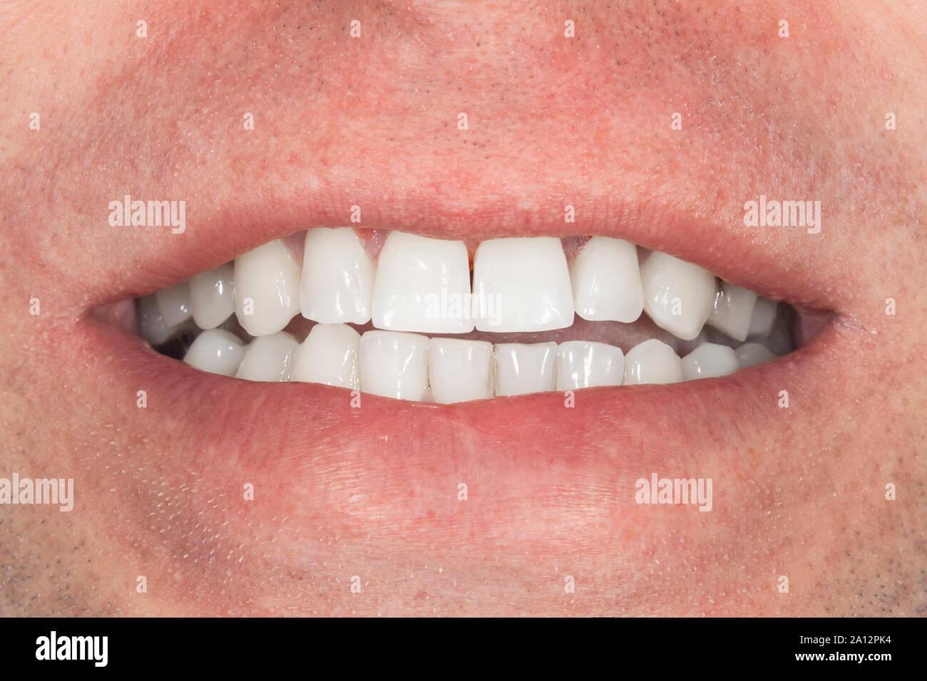 teeth whitening close-up macro. Hygiene of human oral cavity after admission to the dentist Stock Photo