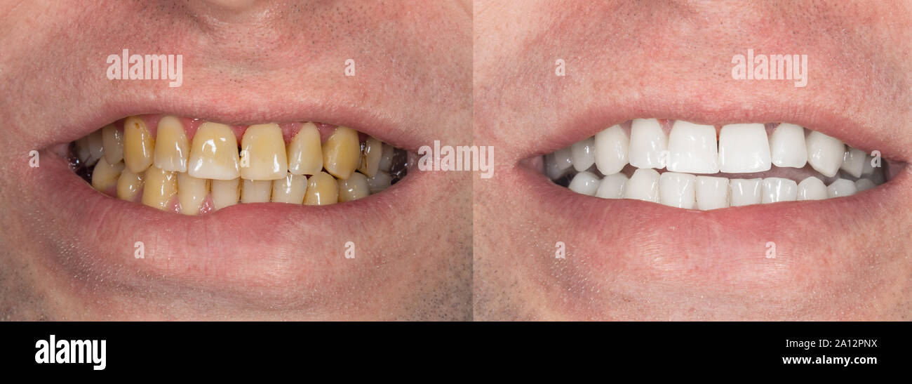 smoking, plaque on teeth human teeth after smoking. Brown resinous