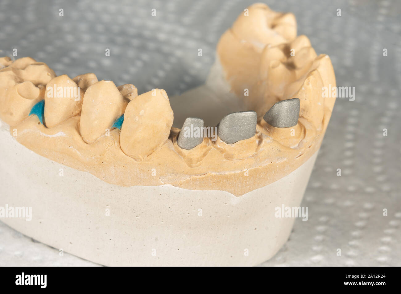 Ceramic tooth crowns and metal pins close-up macro. Orthopedic dentistry restoration decayed teeth Stock Photo