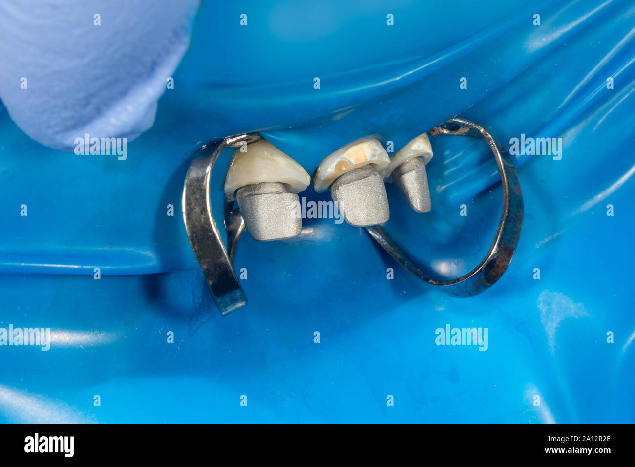 metal cast pin of a human tooth on a gypsum model close-up in dental ...