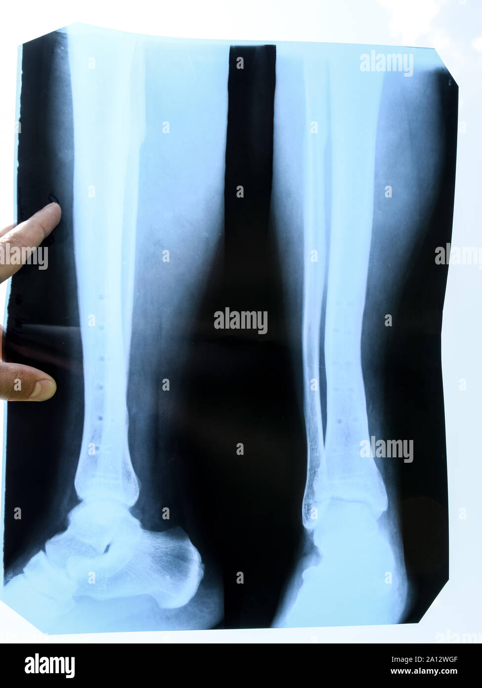 Fused bones of the lower leg after removing the steel bonding plate, x