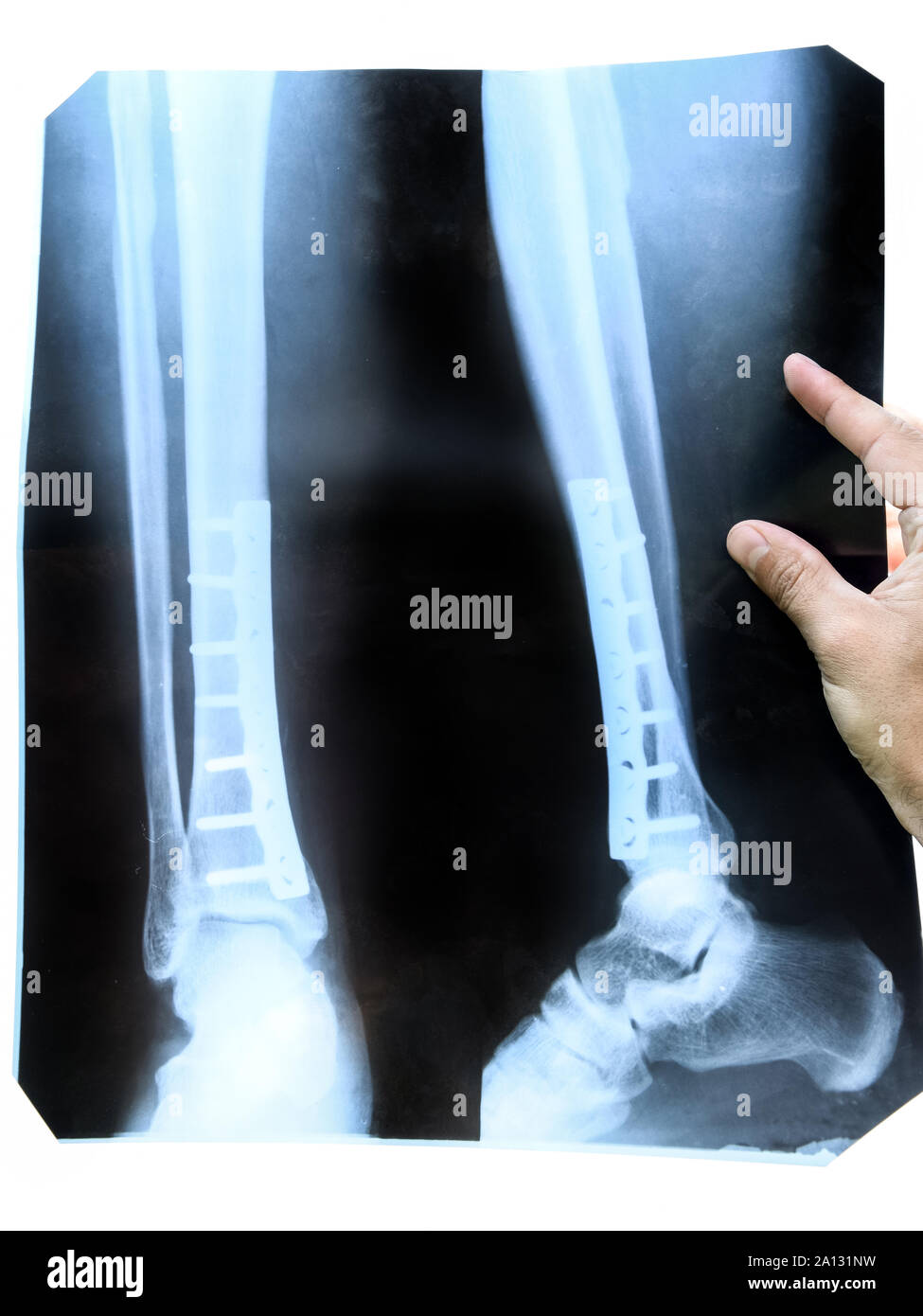 Titanium Plate In Leg