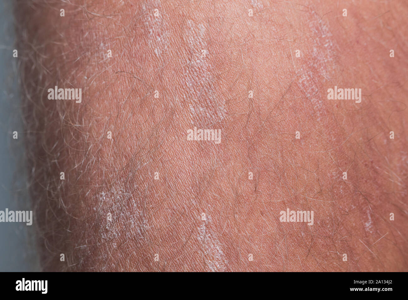 Large plaque parapsoriasis on caucasian man legs Stock Photo Alamy