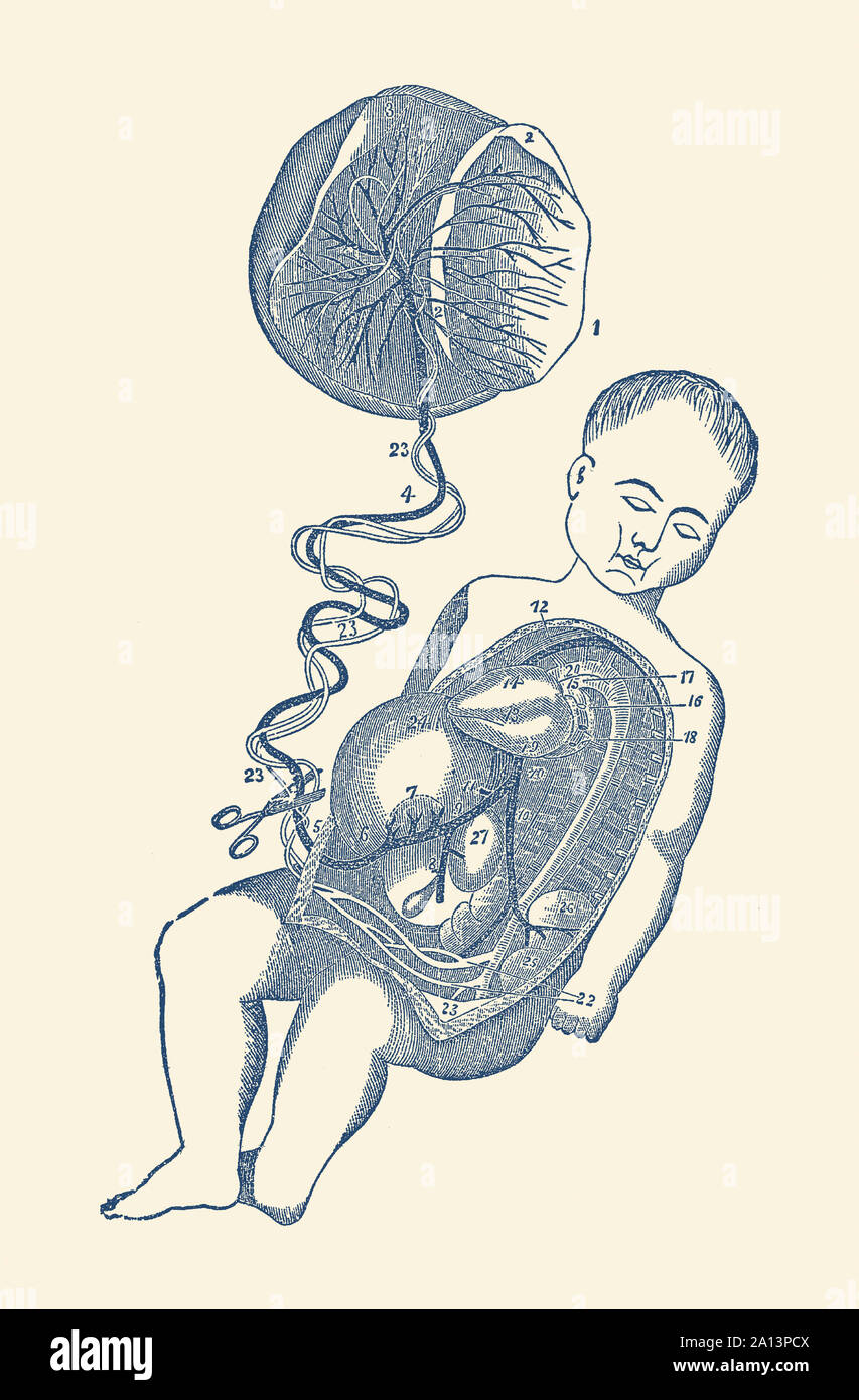 Diagram of the placenta and umbilical cord attached to a baby and position of removal placenta removal. Stock Photo