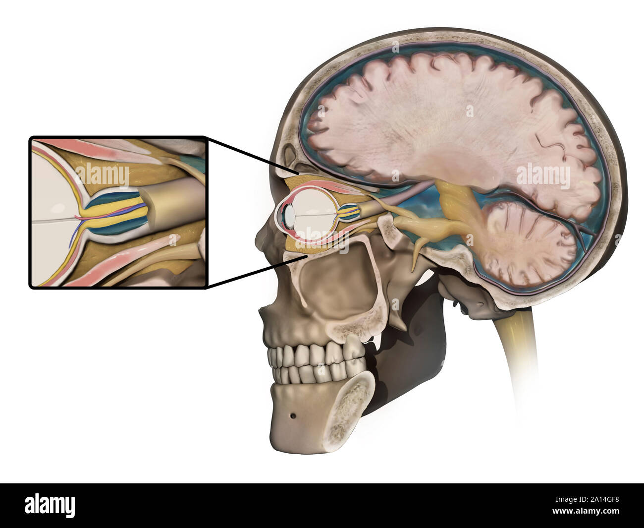 Medical concept shows swelling of the optic nerve caused by increased intracranial pressure. Stock Photo