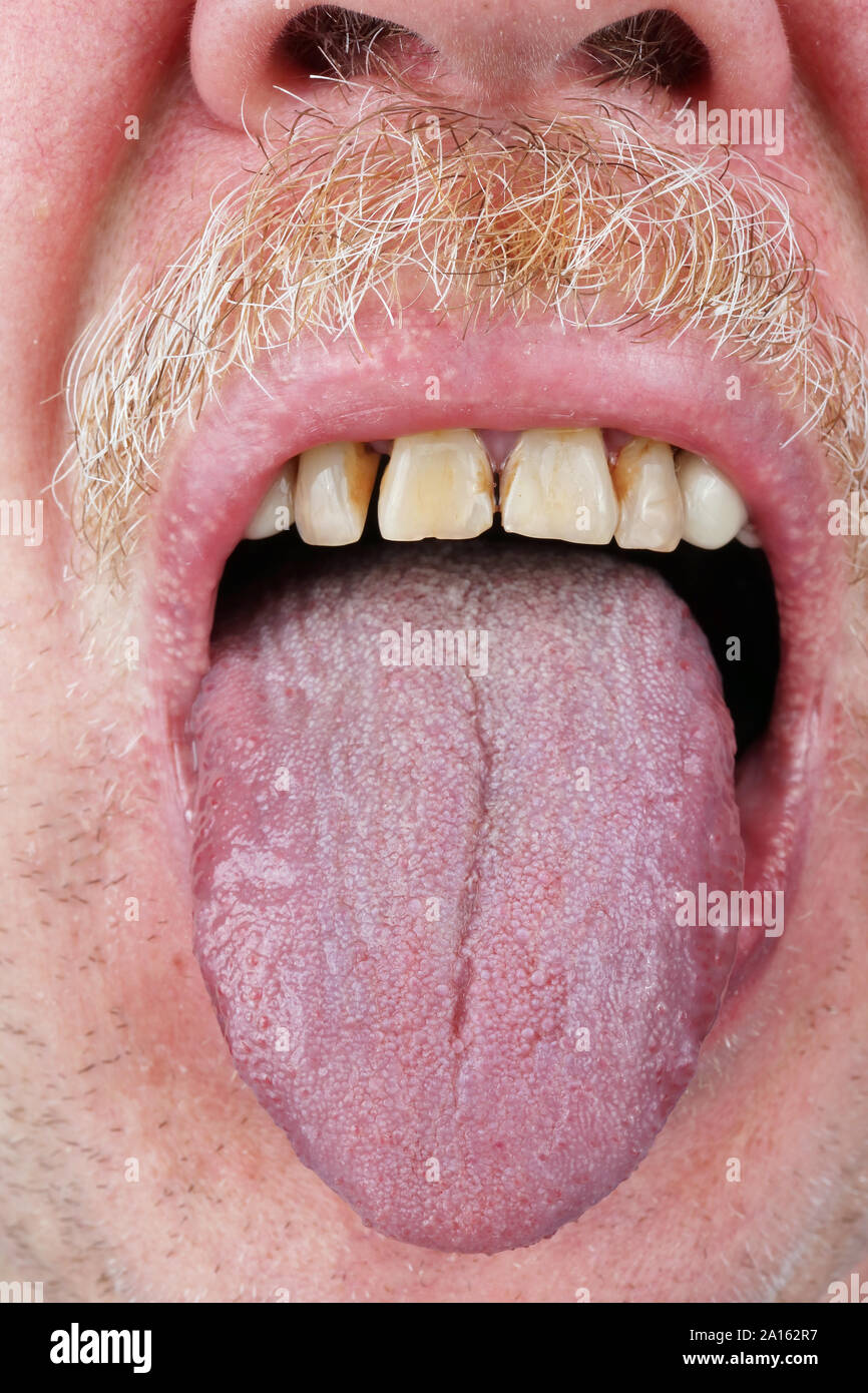 An elderly senior man with yellow teeth shows his tongue to a doctor therapist. Studio macro