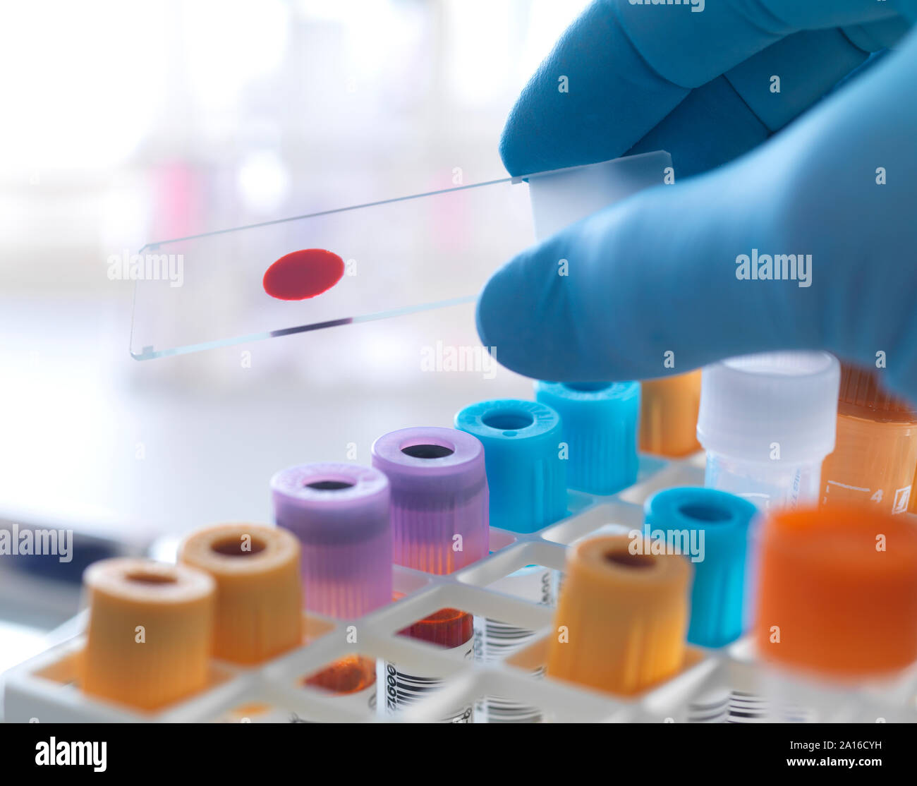 A slide of human blood being held by a technican Stock Photo