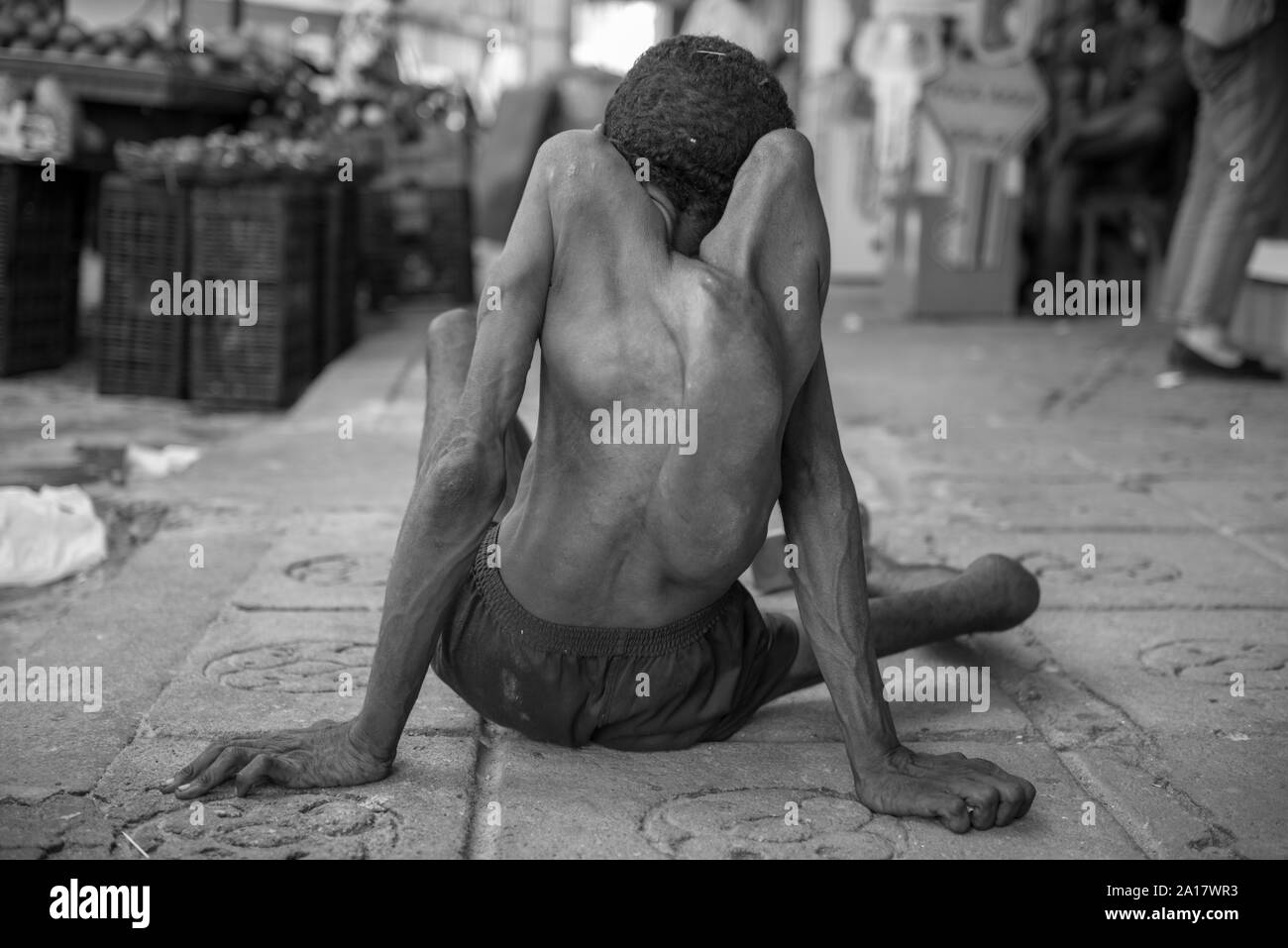 Homeless man with congenital disease facing life in the streets Stock Photo