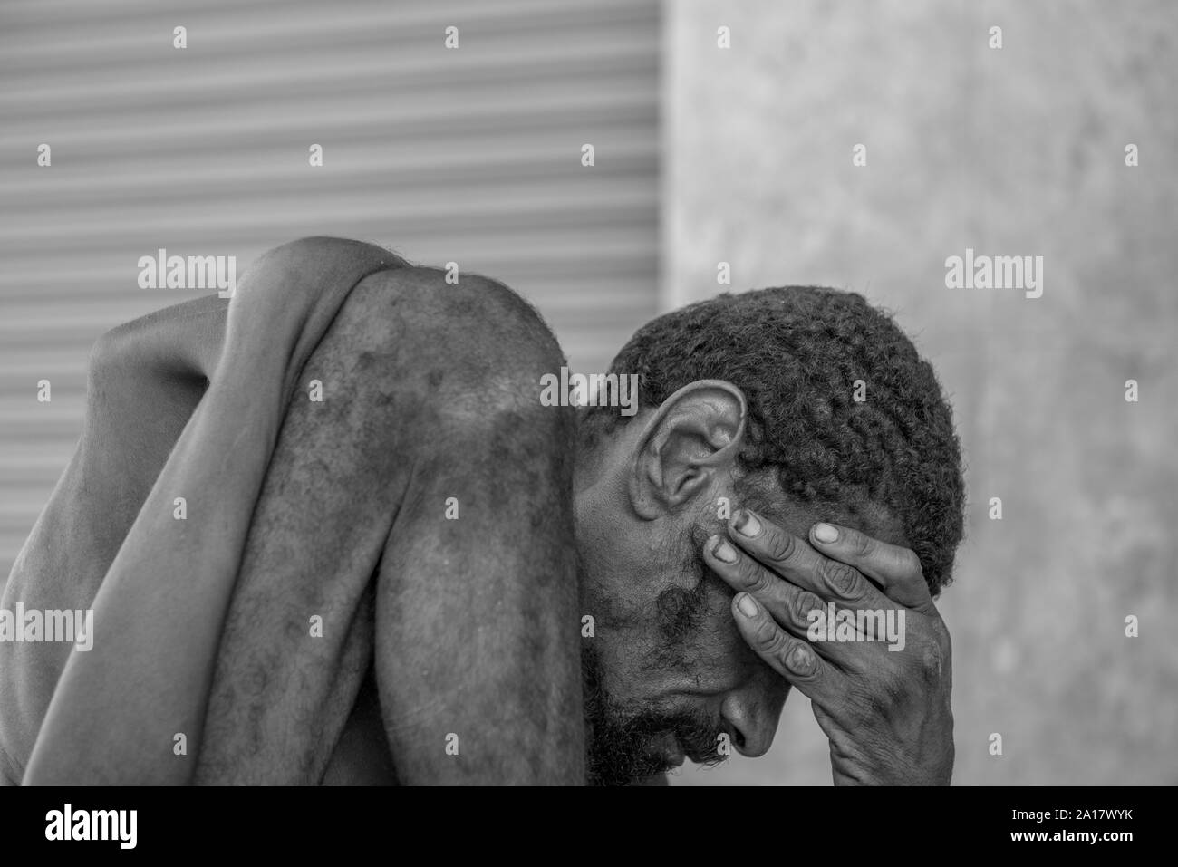 Shocking portrait of homeless man with congenital disease in Recife Stock Photo