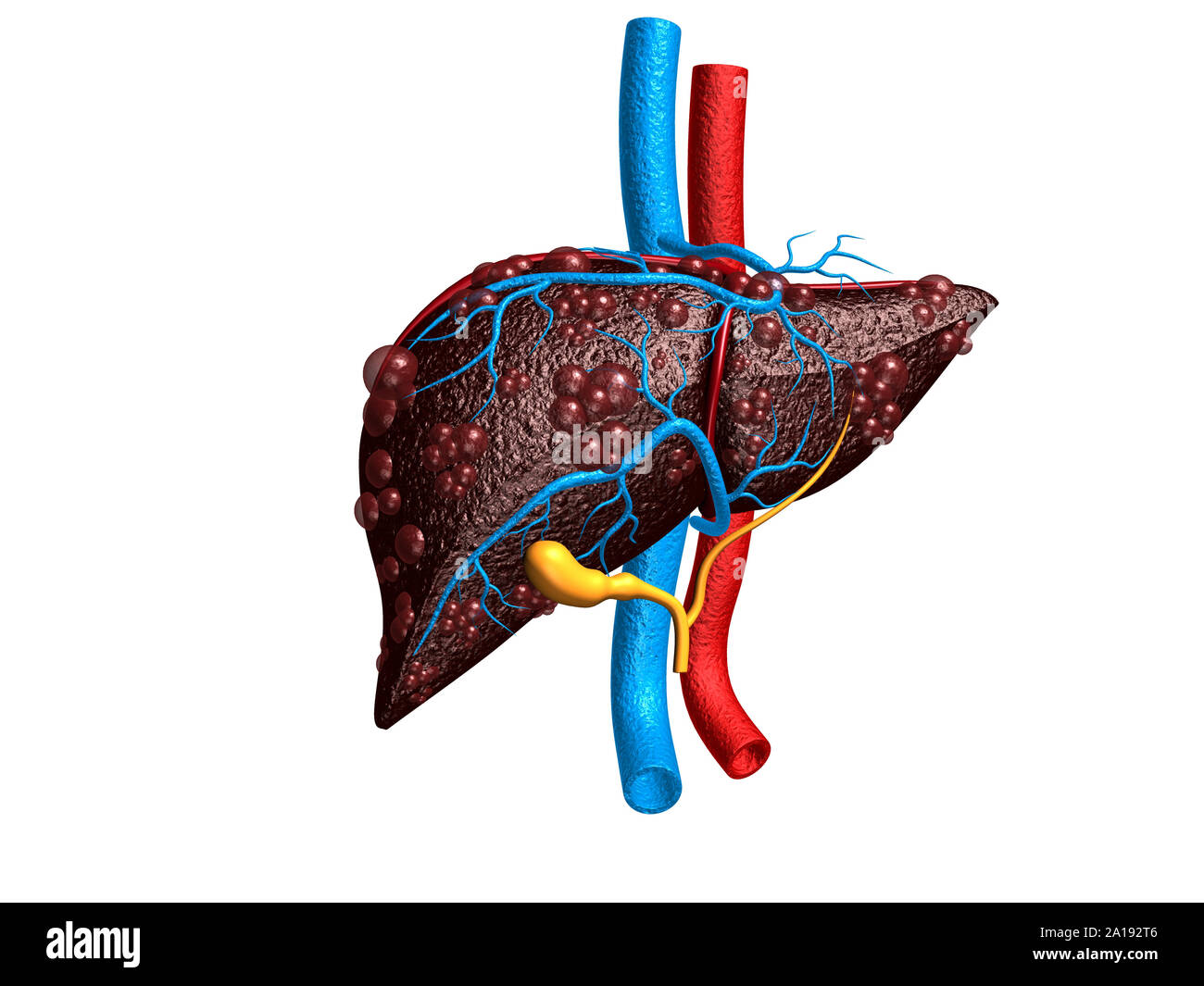 Diseased liver. 3d render Stock Photo