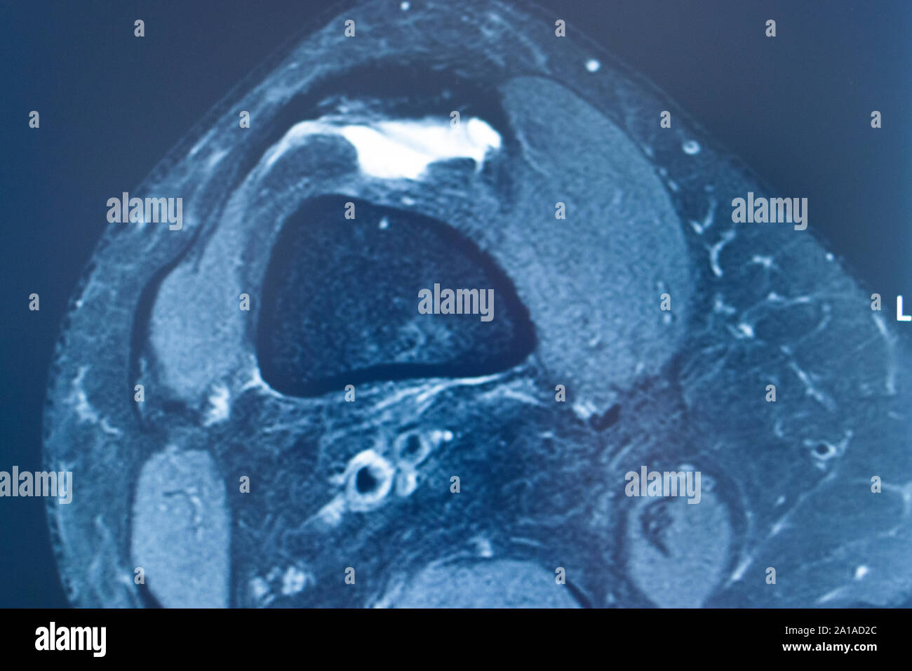 Knee sports injury mri mcl grade 2 tear resonance imaging