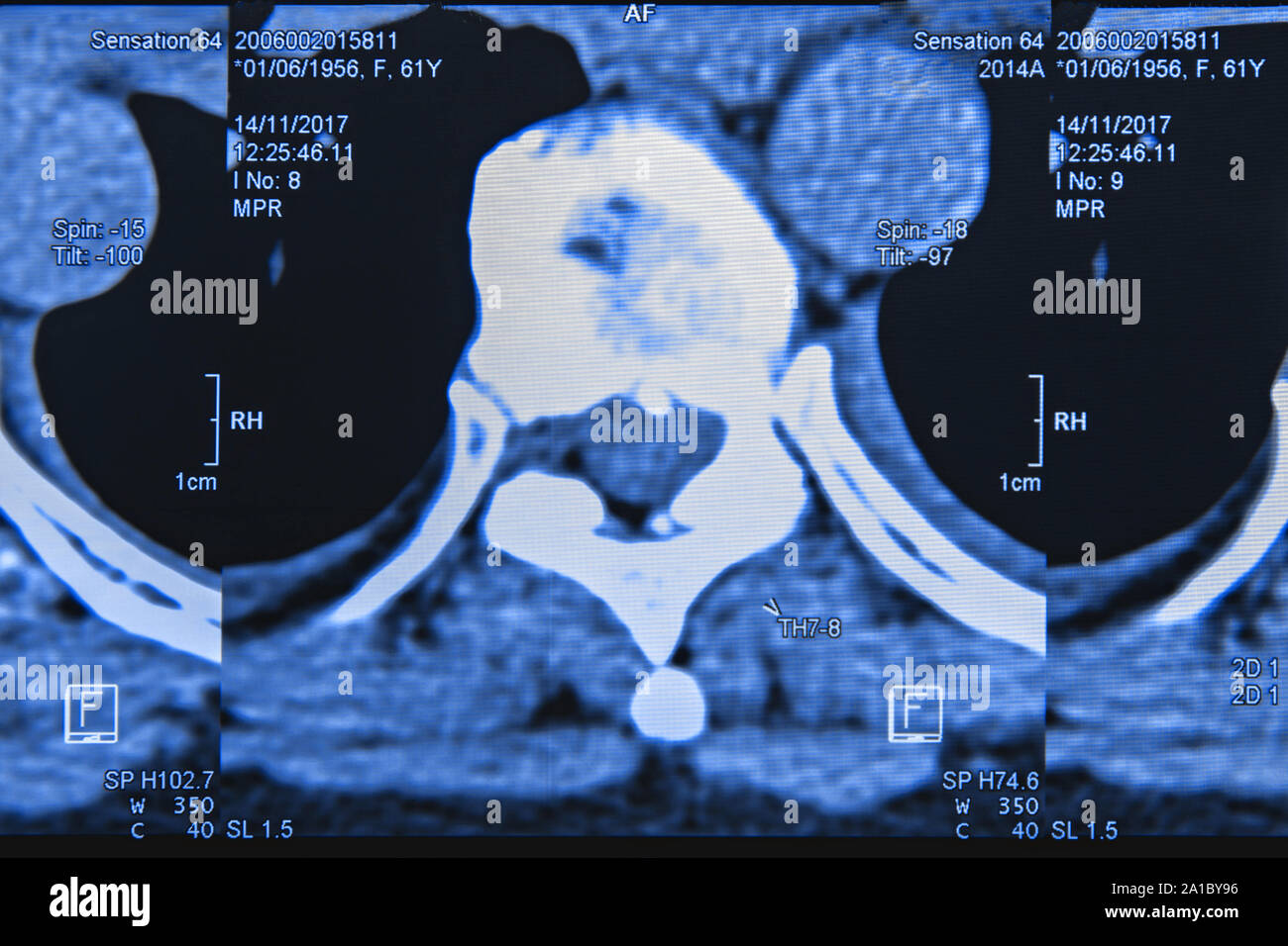 Mri of back pain hires stock photography and images Alamy