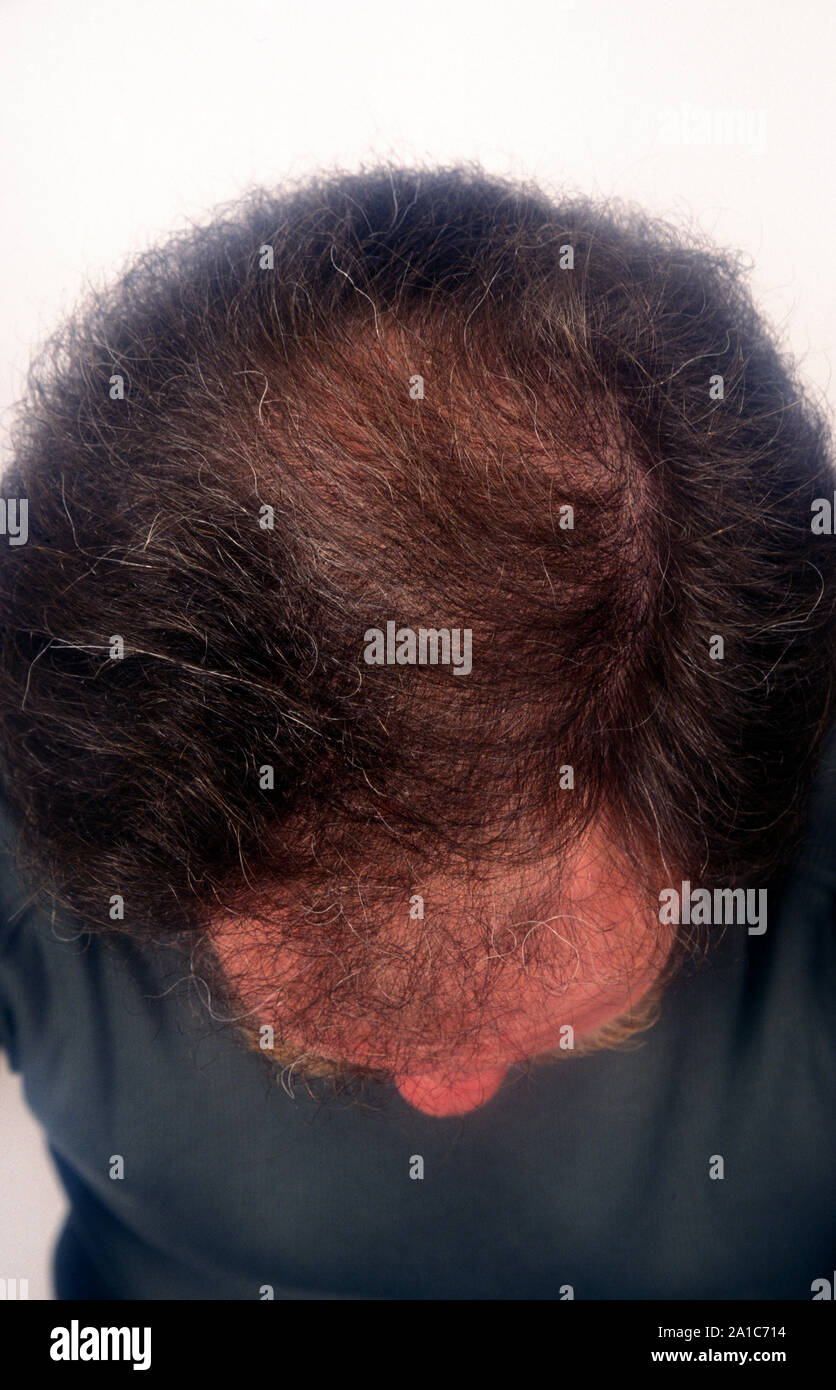 male pattern baldness, top of middle aged mans head Stock Photo