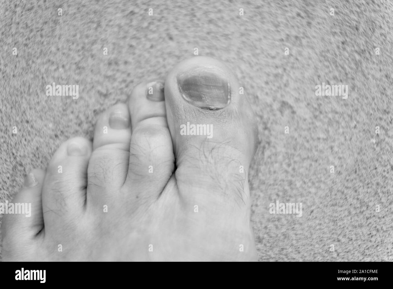 finger disease. hematoma. toe injury. bruise and trauma treatment