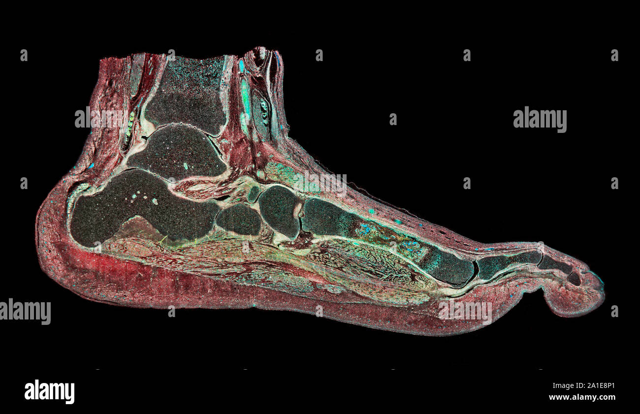 Human fetal foot section showing general structure, darkfield photomicrograph Stock Photo
