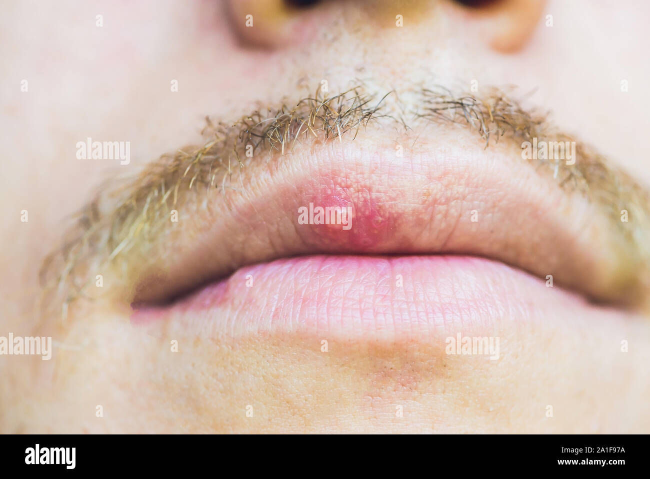 Virus herpes infected on male lip, closeup. Stock Photo
