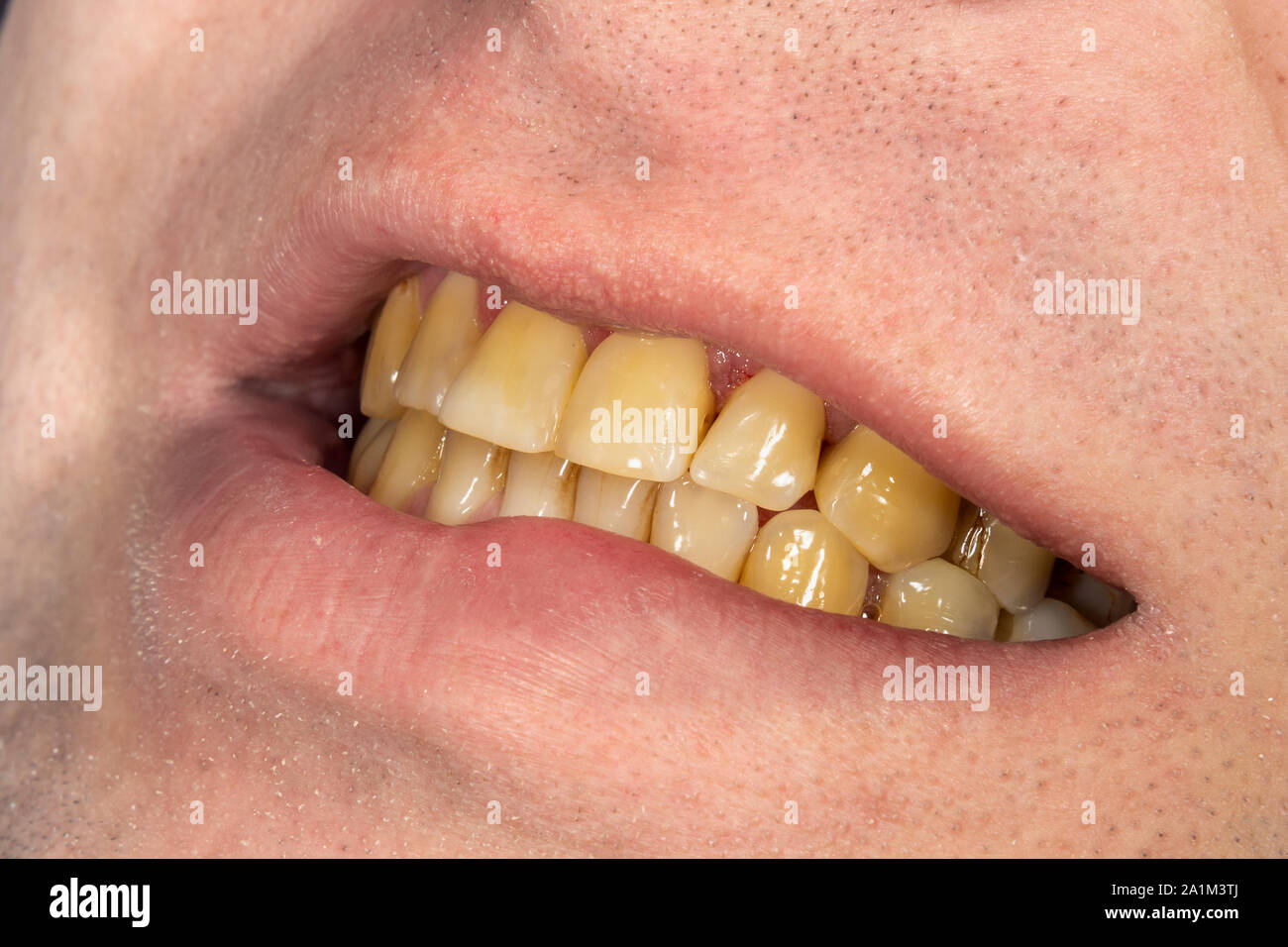 smoking, plaque on teeth human teeth after smoking. Brown resinous
