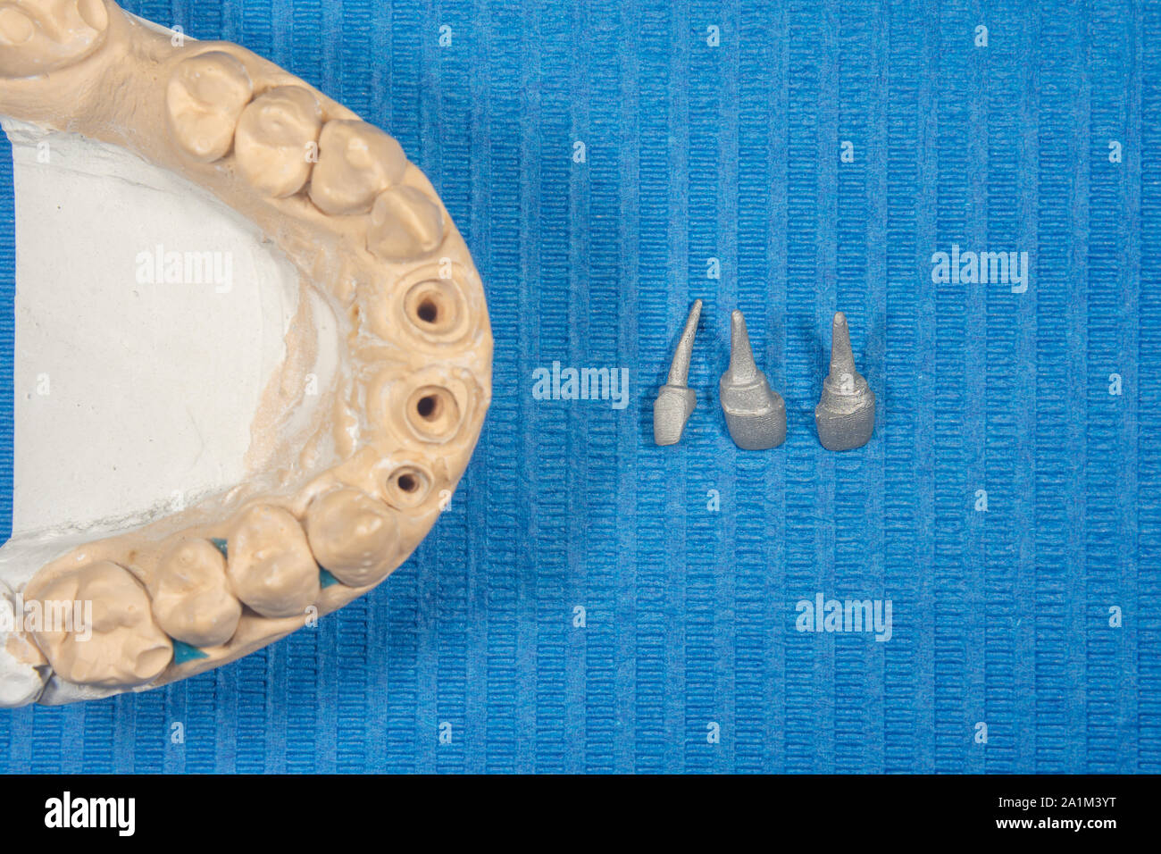 Ceramic tooth crowns and metal pins close-up macro. Orthopedic dentistry restoration decayed teeth Stock Photo