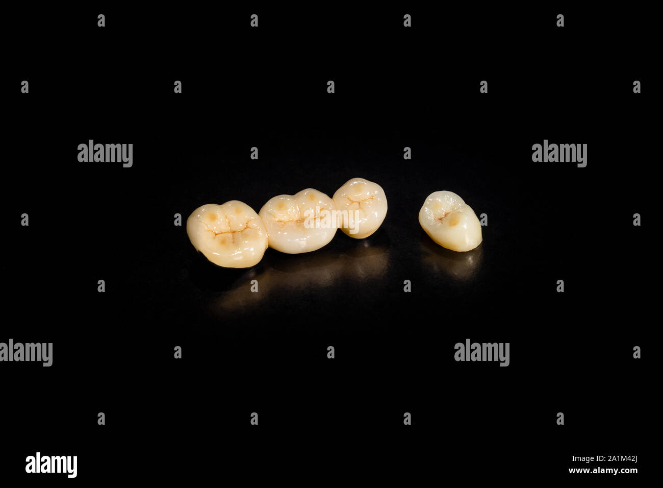 Ceramic tooth crowns and metal pins close-up macro. Orthopedic dentistry restoration decayed teeth Stock Photo