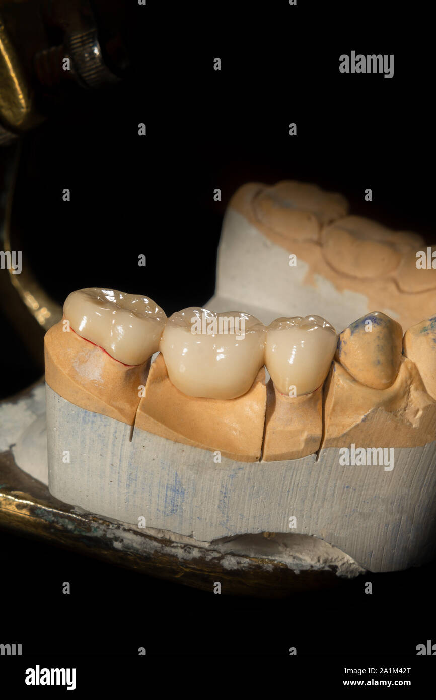 Ceramic tooth crowns and metal pins close-up macro. Orthopedic dentistry restoration decayed teeth Stock Photo