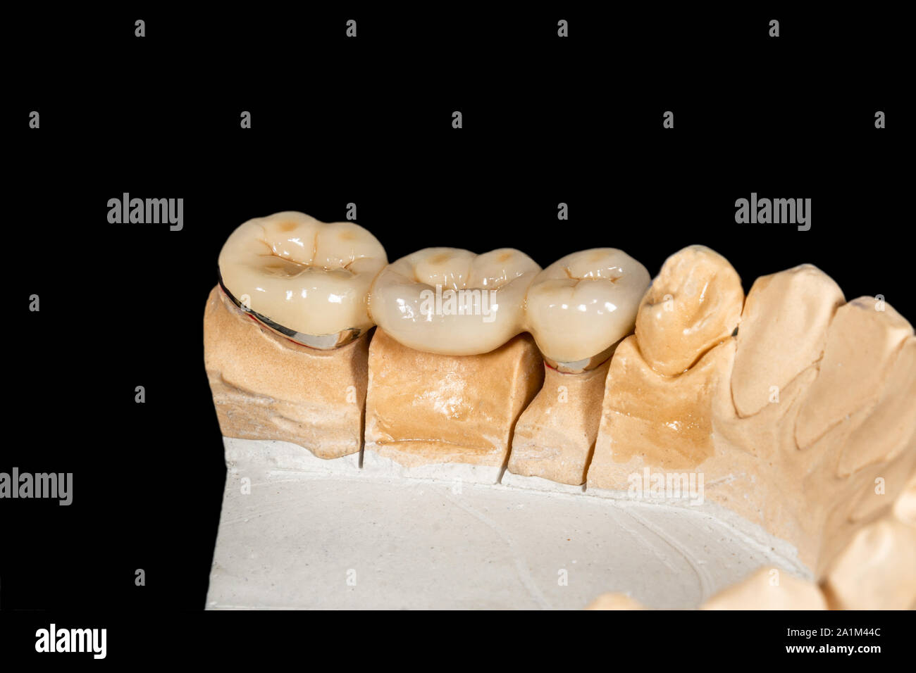 Ceramic tooth crowns and metal pins close-up macro. Orthopedic dentistry restoration decayed teeth Stock Photo