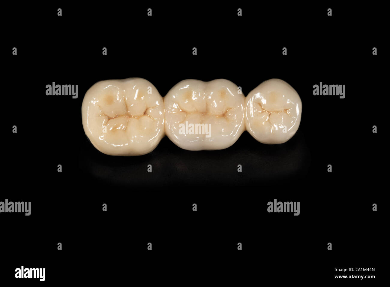 Ceramic tooth crowns and metal pins close-up macro. Orthopedic dentistry restoration decayed teeth Stock Photo