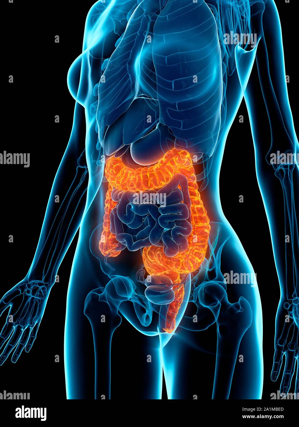 Damage Colon Diseased colon, computer illustration Stock Photo - Alamy