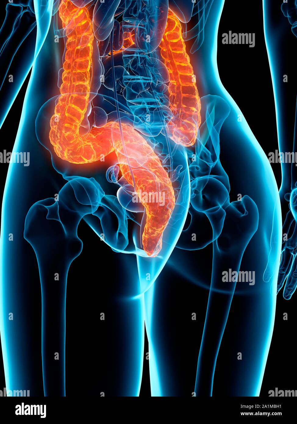 Damage Colon Diseased colon, computer illustration Stock Photo - Alamy