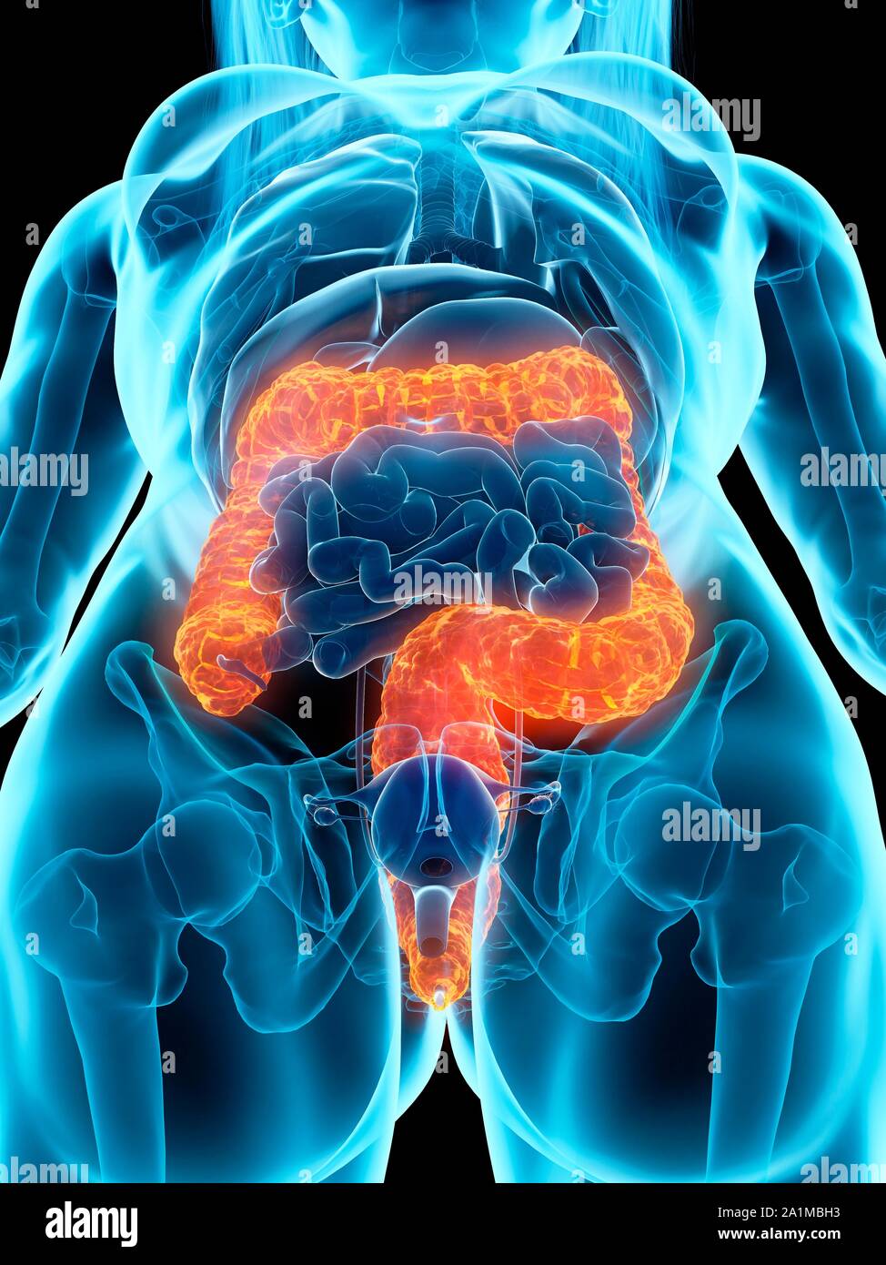 Damage Colon Diseased colon, computer illustration Stock Photo - Alamy