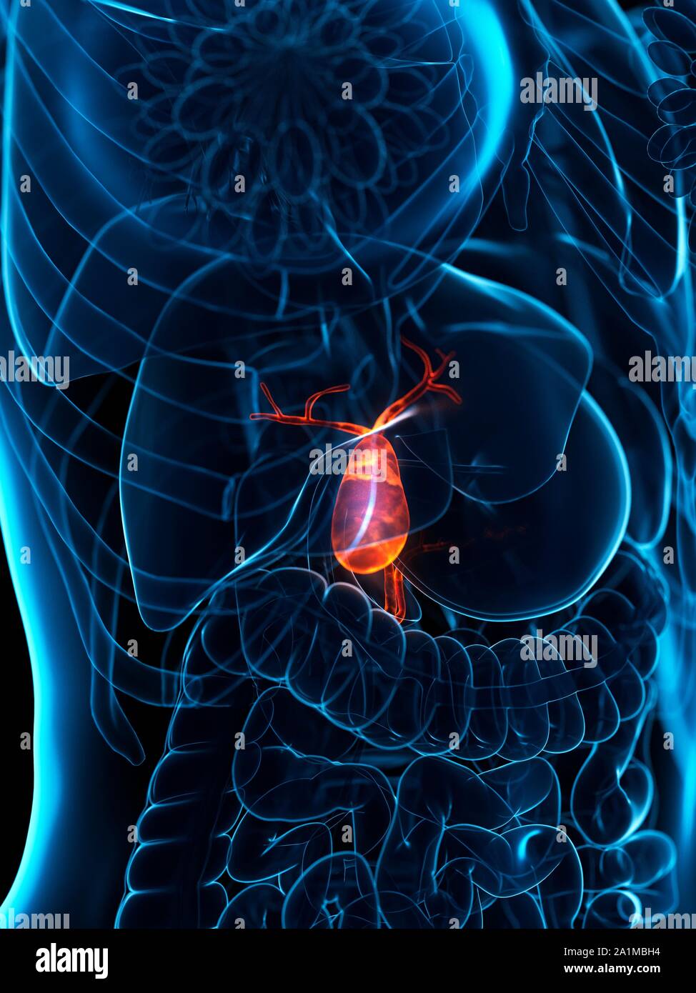 Diseased gallbladder, computer illustration Stock Photo