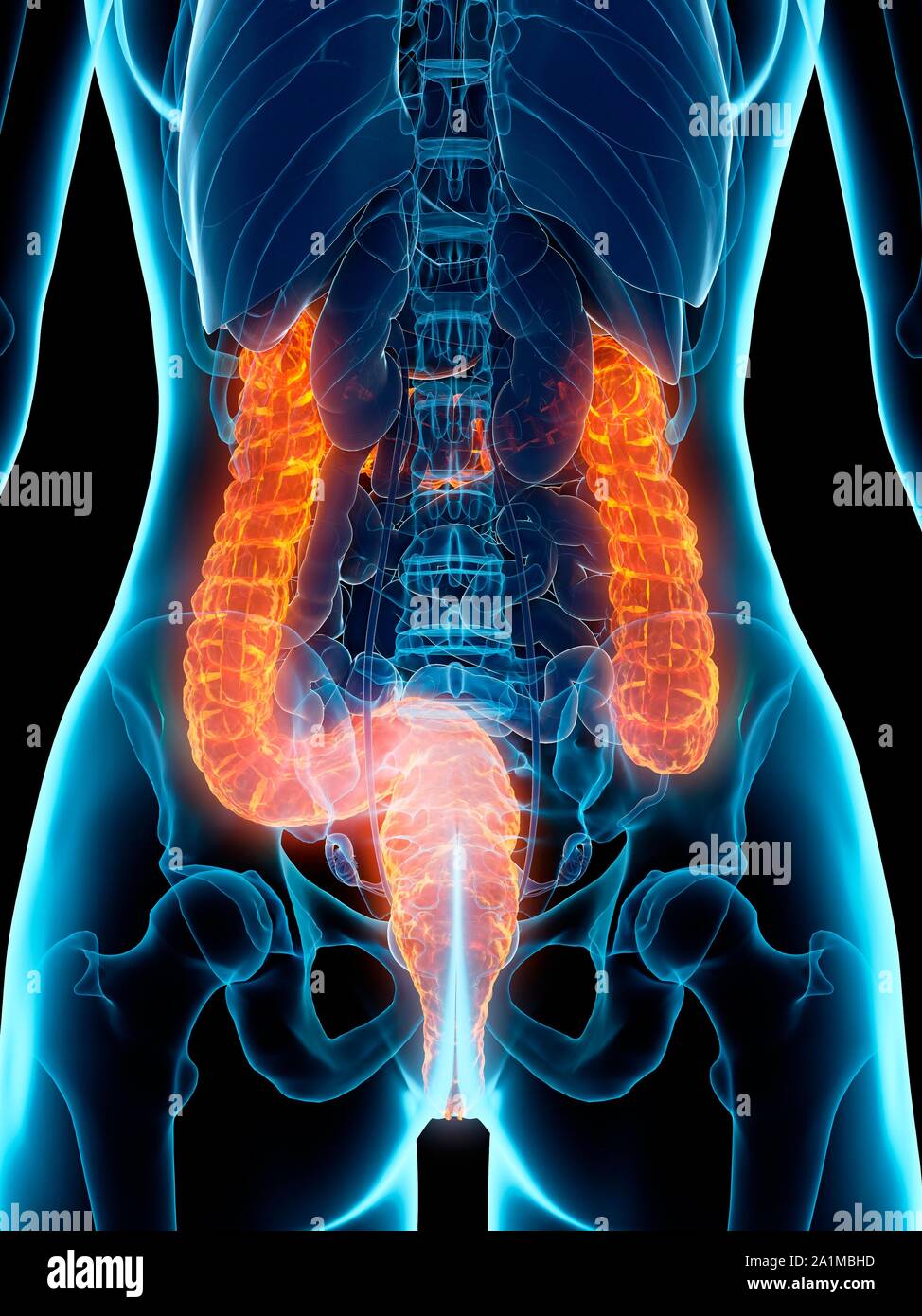 Damage Colon Diseased colon, computer illustration Stock Photo - Alamy