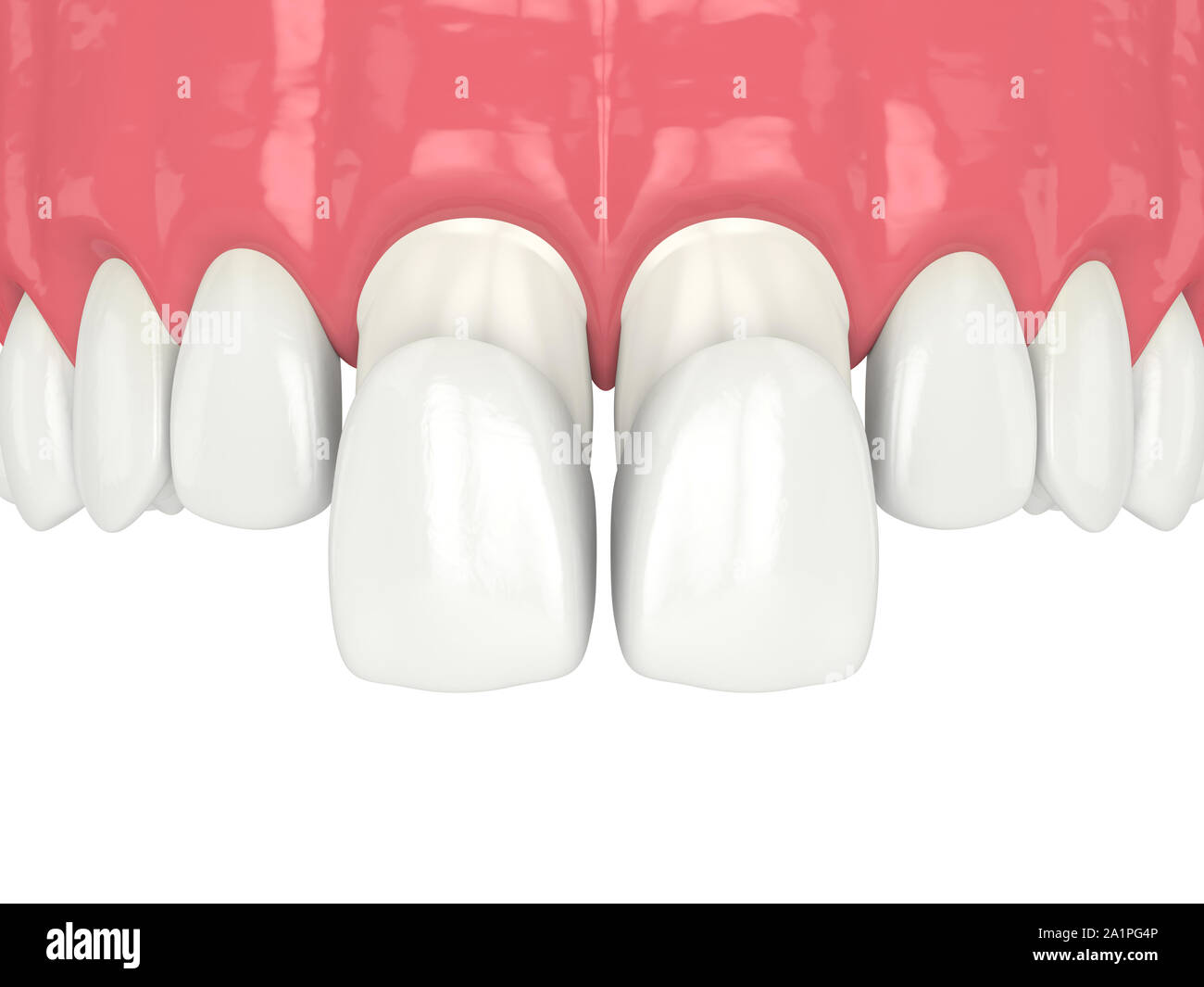 3d render of upper jaw with veneers over white Stock Photo