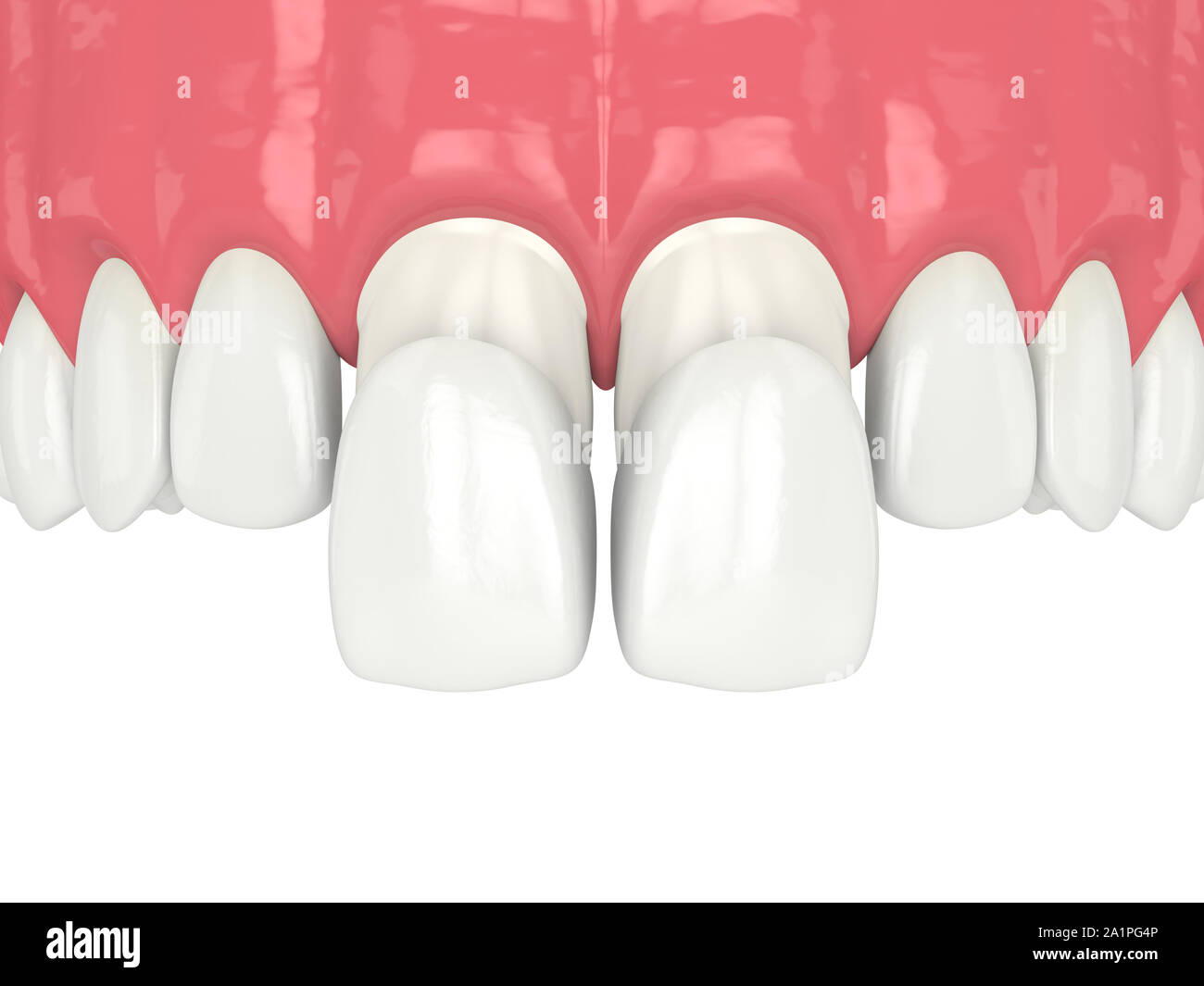 3d render of upper jaw with veneers over white Stock Photo - Alamy