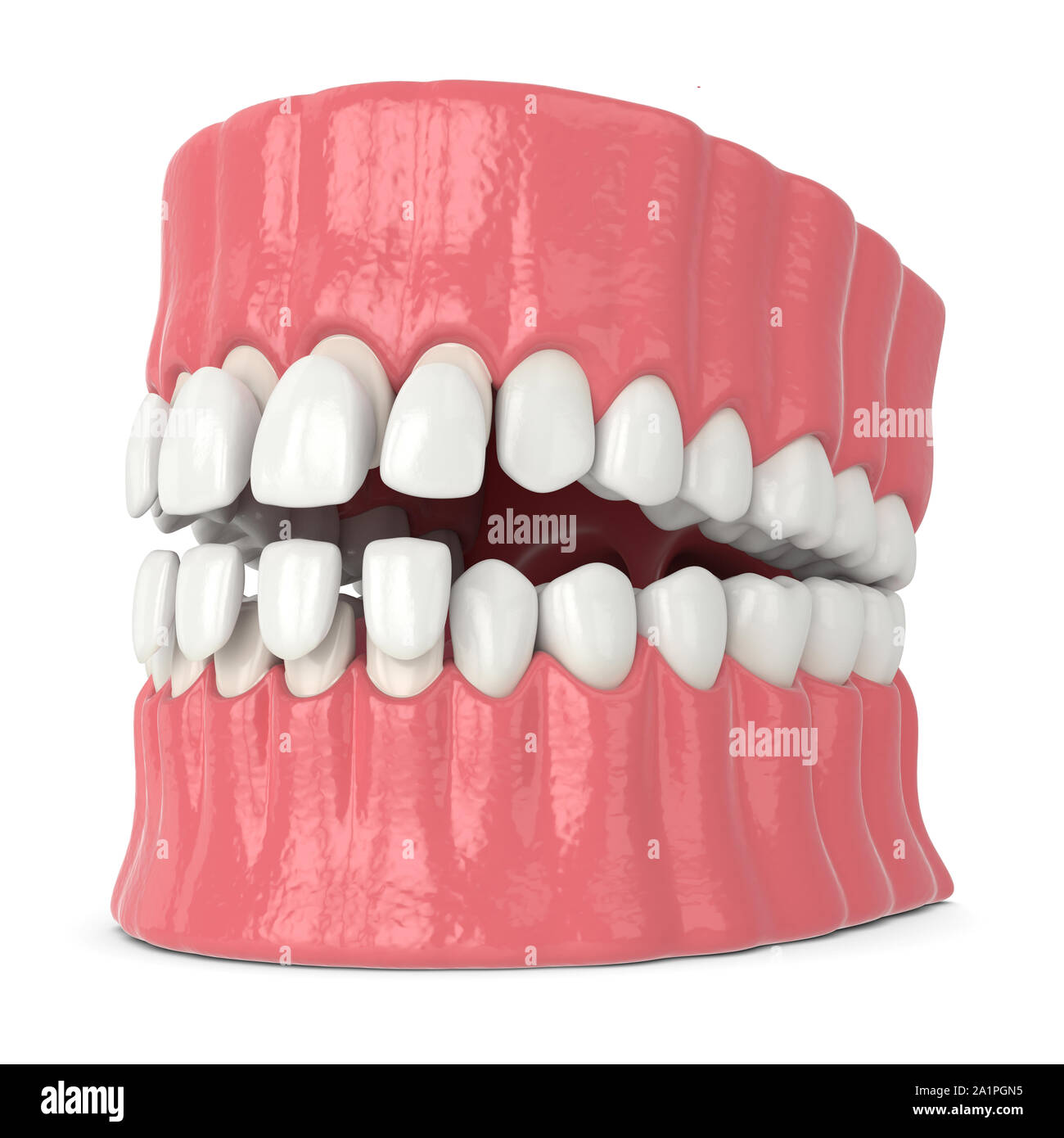 3d render of jaw with upper and lower veneers over white background Stock Photo