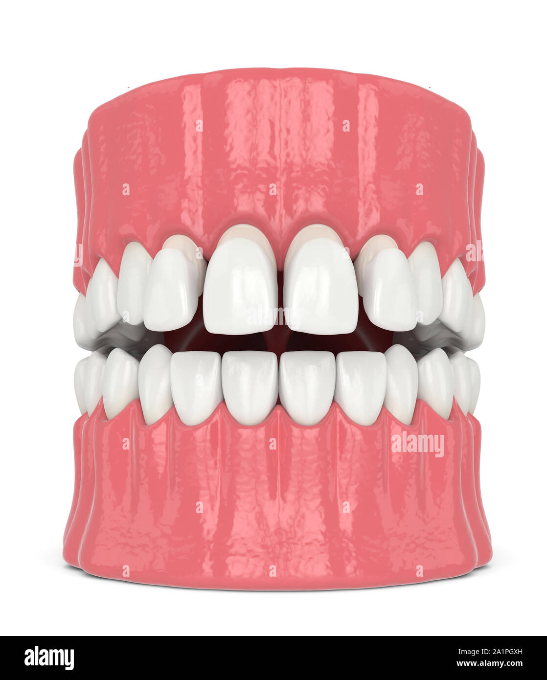 3d render of jaw with upper veneers over white Stock Photo