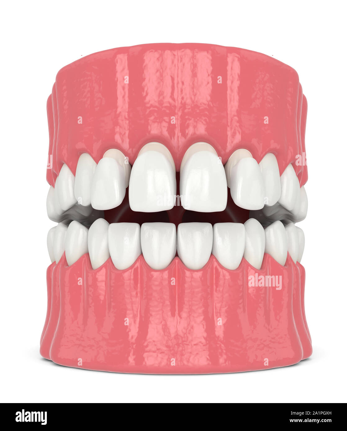 3d render of jaw with upper veneers over white Stock Photo - Alamy