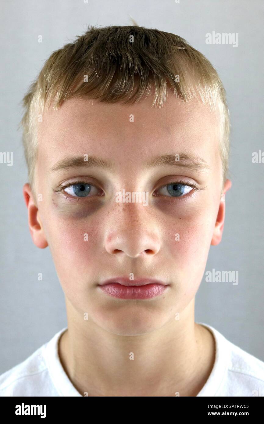 Portrait of a serious boy with a black eye Stock Photo