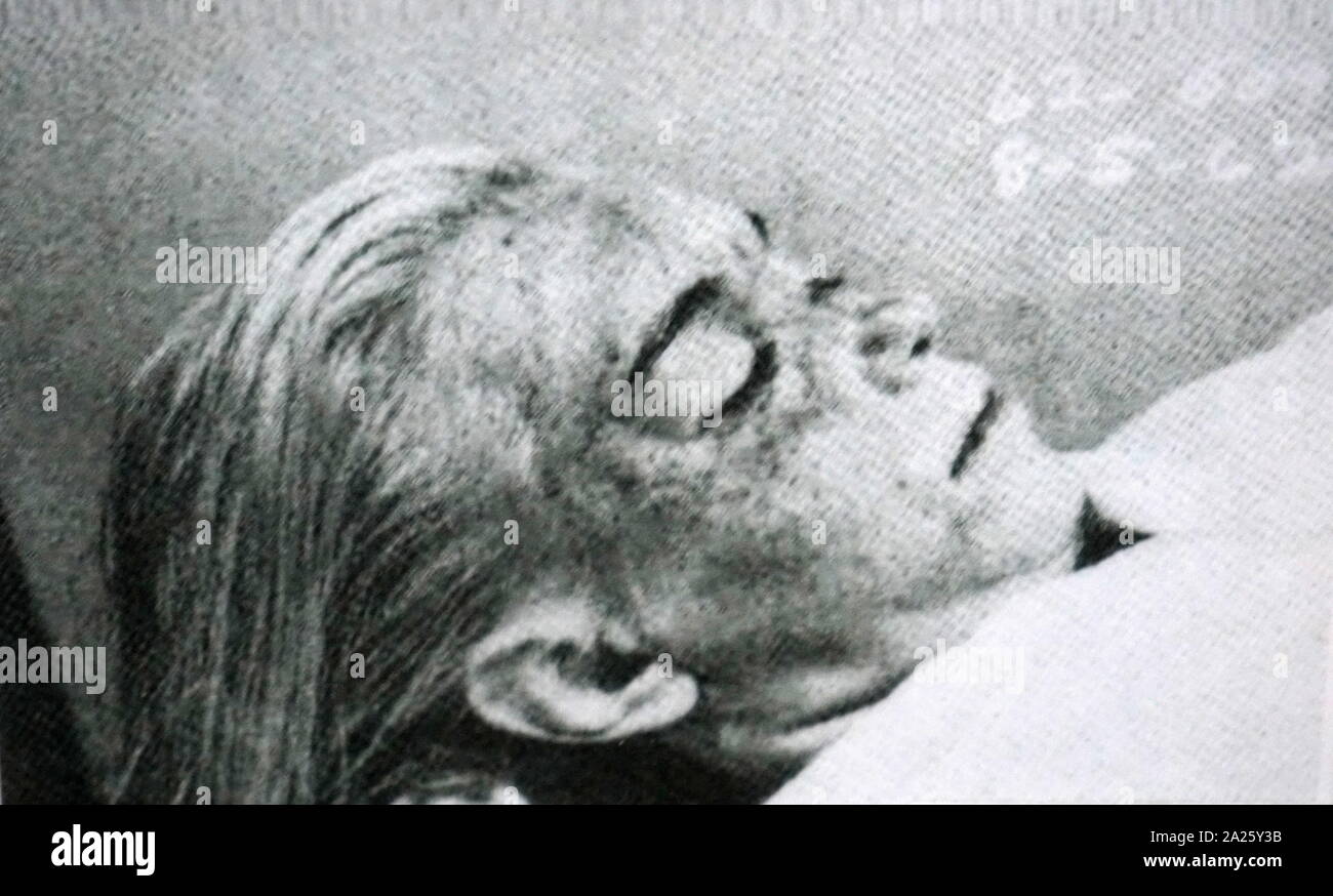 Marilyn Monroe's autopsy photograph. Marilyn Monroe (1926-1962) an American actress, model, and singer. Stock Photo