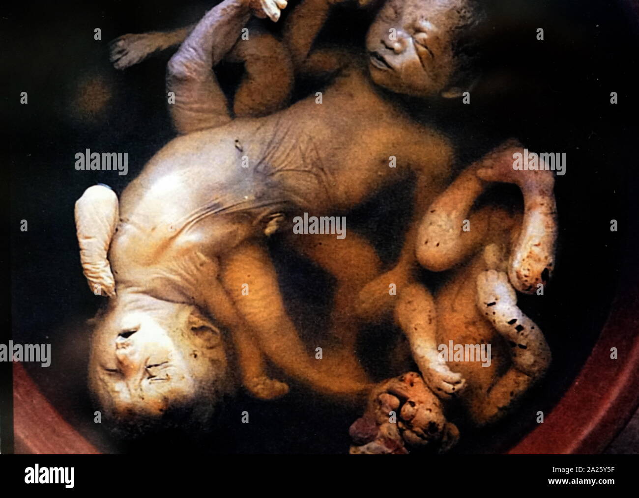 Vietnamese stillborn babies who suffered with deformities as a result of prenatal exposure to dioxin from Agent Orange. Stock Photo