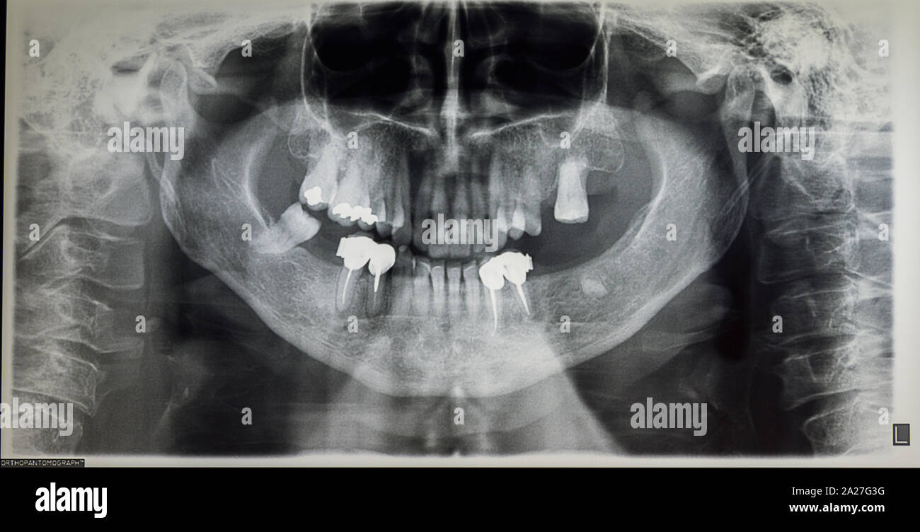 Ortopantomography Orthopantomography of an adult patient, dentistry Stock Photo - Alamy