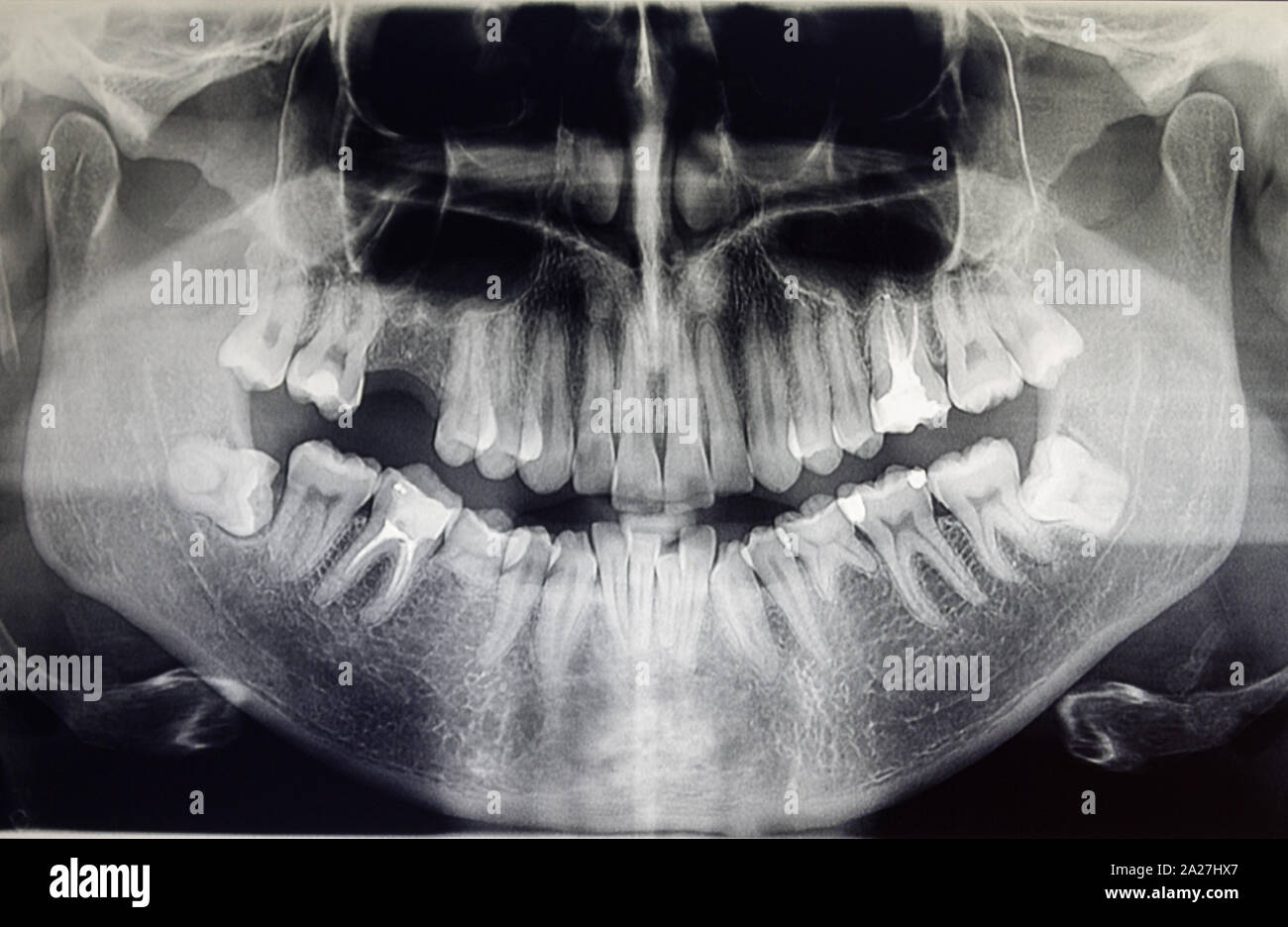 Ortopantomography Orthopantomography of an adult patient, dentistry Stock Photo - Alamy