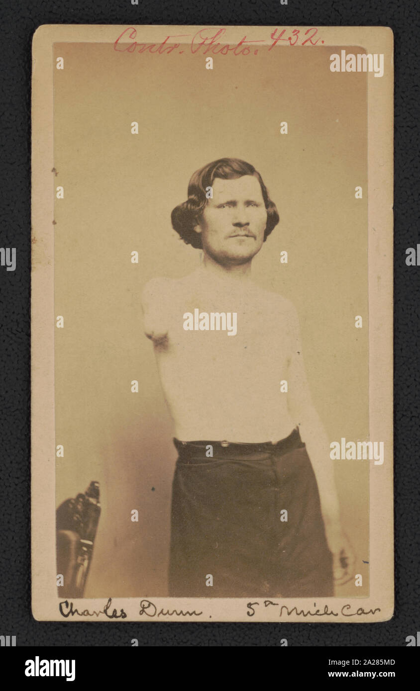 Private Charles Dunn of Co. L, 5th Michigan Cavalry Regiment, without shirt, displaying arm amputation Stock Photo