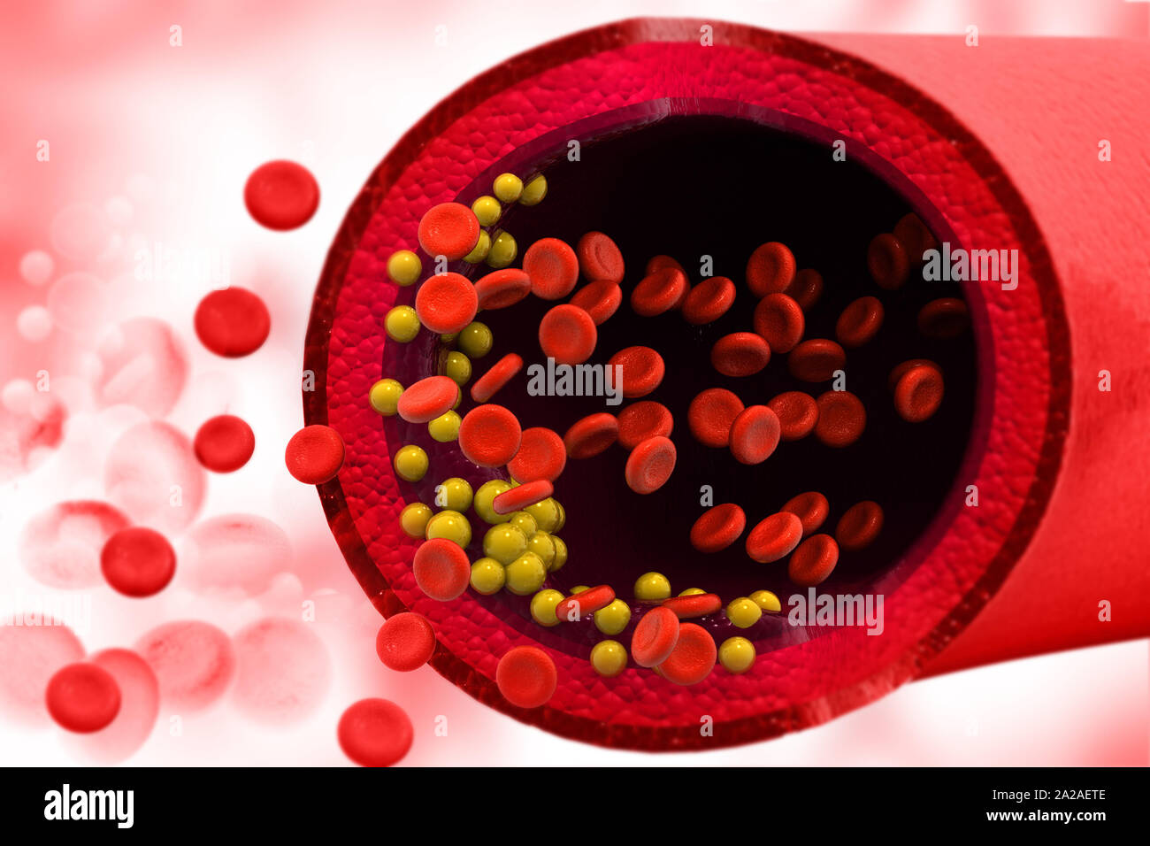 Cholesterol plaque in blood vessel. Medical background. 3d illustration