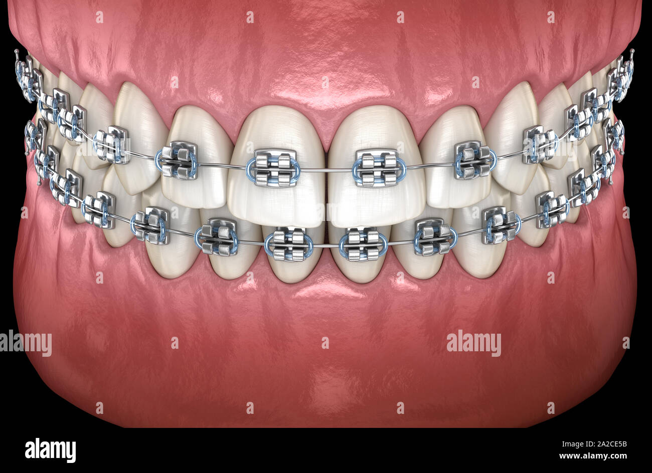 Teeth with metal braces in gums. Medically accurate dental 3D