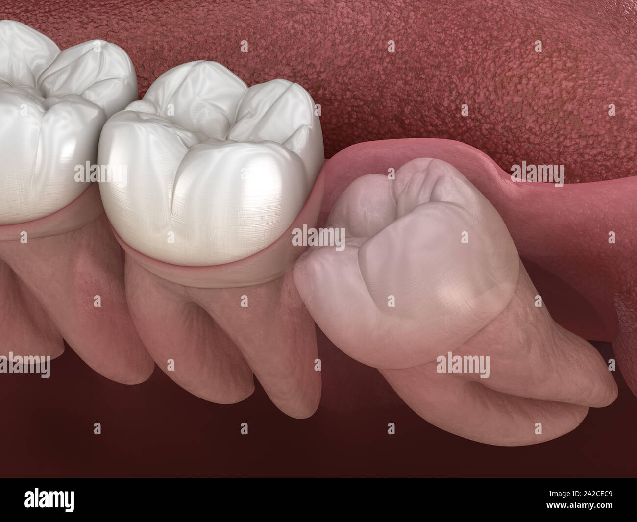 Healthy teeth and wisdom tooth with mesial impaction . Medically accurate tooth 3D illustration Stock Photo