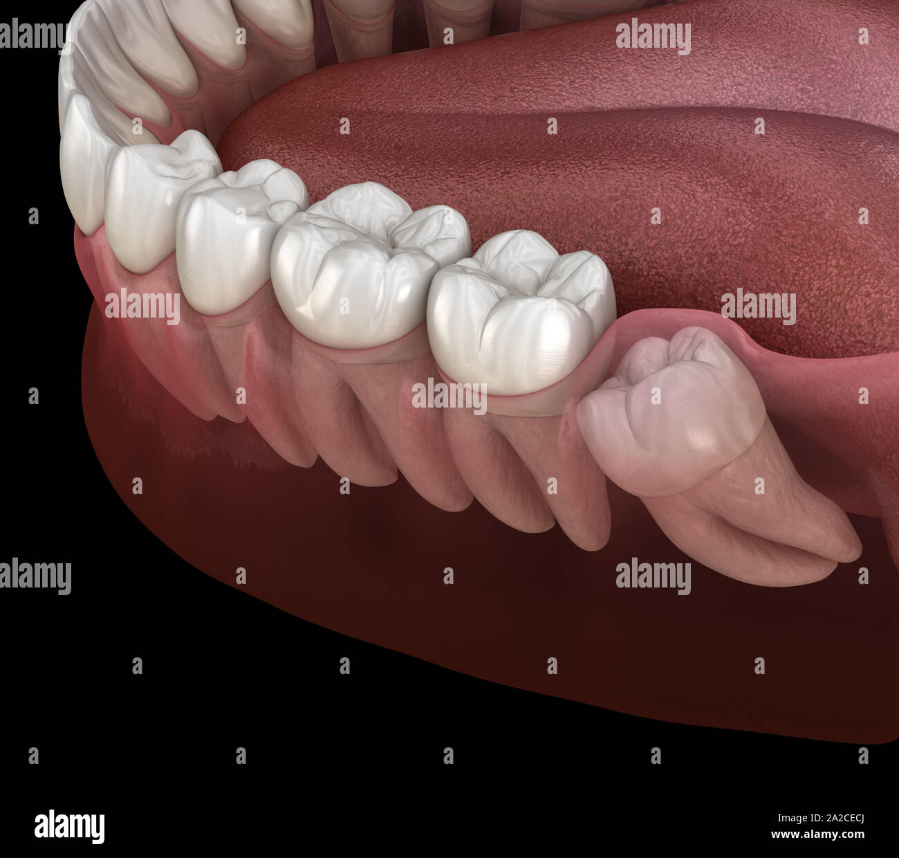 Healthy teeth and wisdom tooth with mesial impaction . Medically accurate tooth 3D illustration Stock Photo