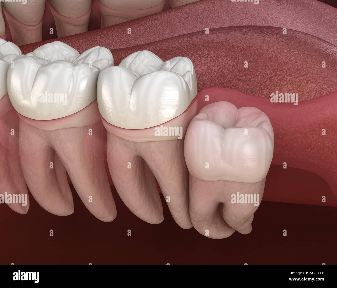 Healthy teeth and wisdom tooth with vertical impaction . Medically accurate tooth 3D illustration Stock Photo