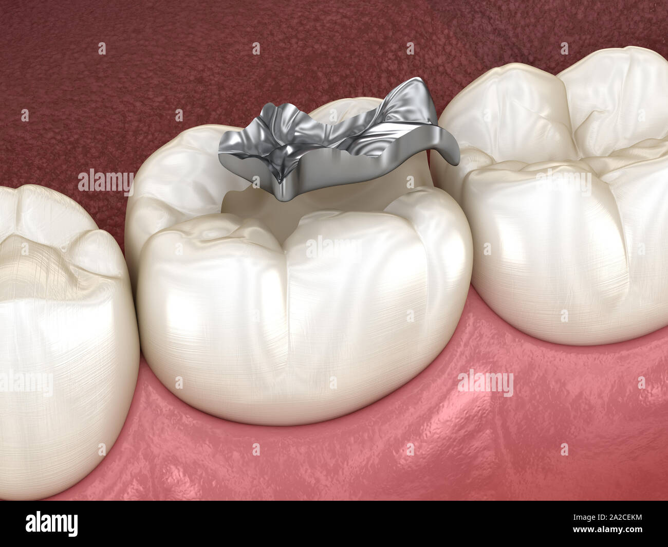 Silver Inlay Tooth Inlay silver crown fixation over tooth. Medically accurate 3D ...